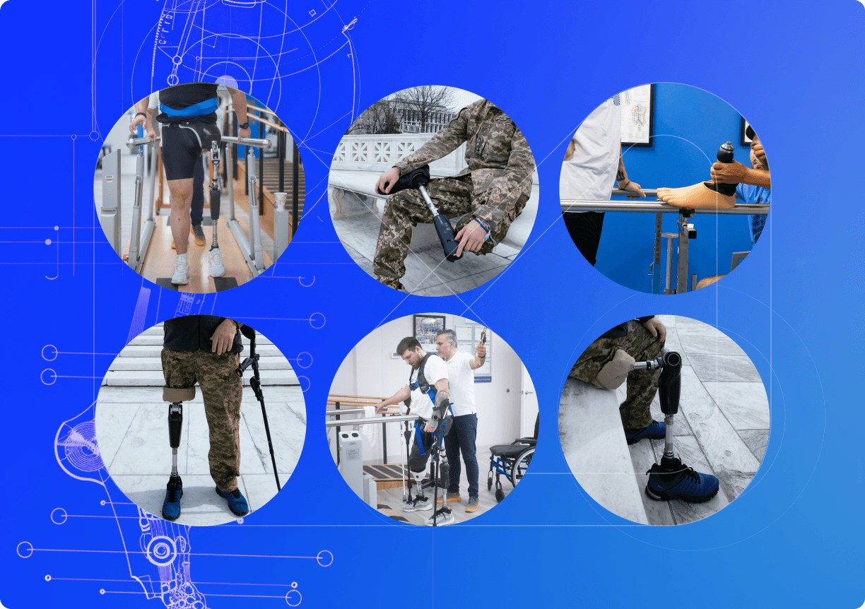 Протезування нижніх кінцівок