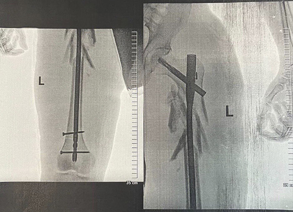 Нога Олександра після встановлення системи металоостеосинтезу