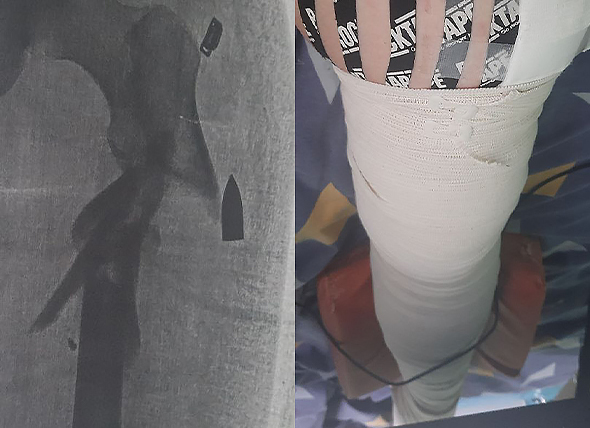 Рентген ноги Олександра з кулею